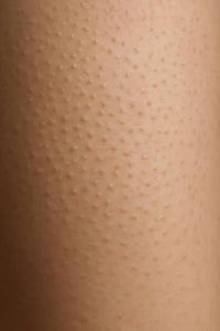 Textura irregular y células muertas