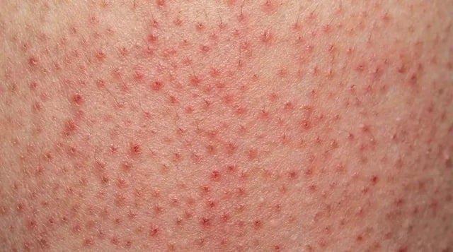 Marcas oscuras por irritación o depilación